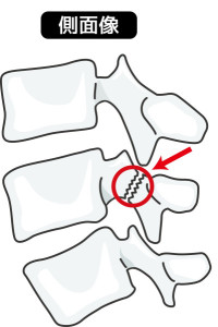 分離症　背骨　スポーツ