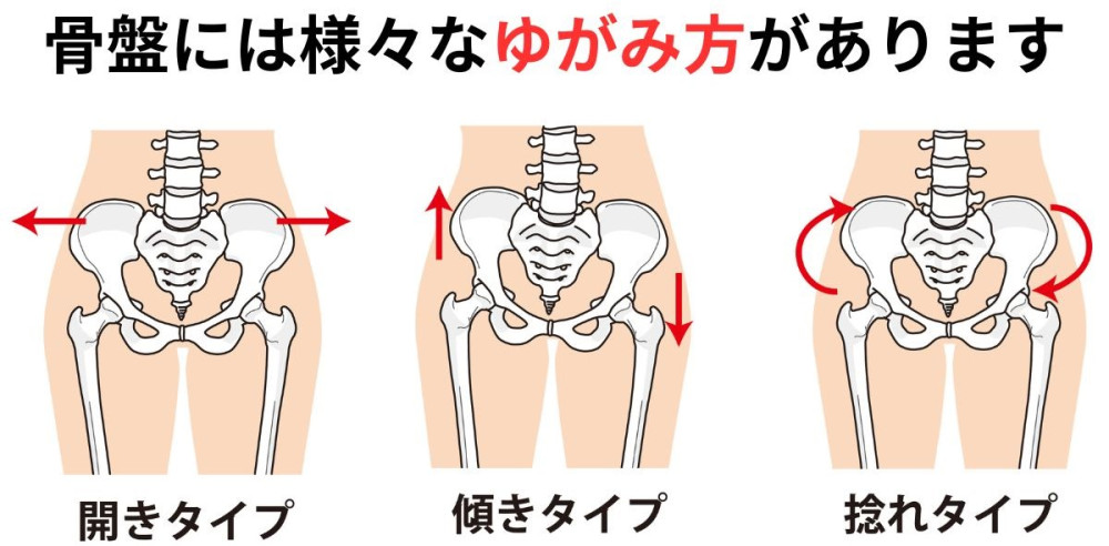 骨盤　ゆがみ