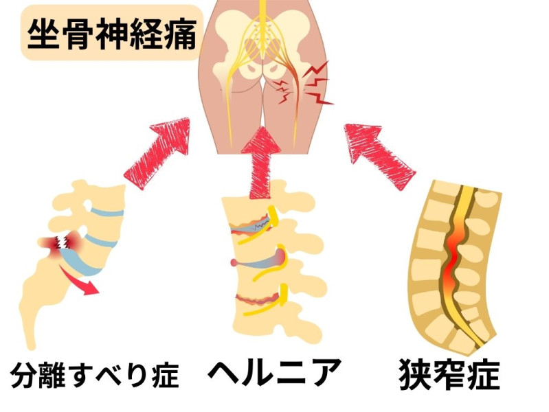 坐骨神経痛　各症状